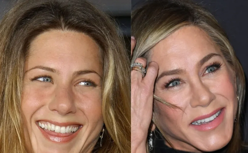 jennifer aniston teeth before after