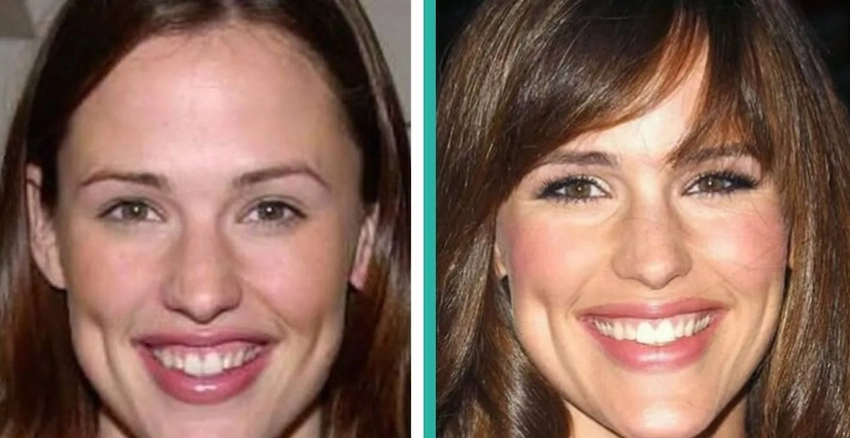 jennifer garner teeth before after