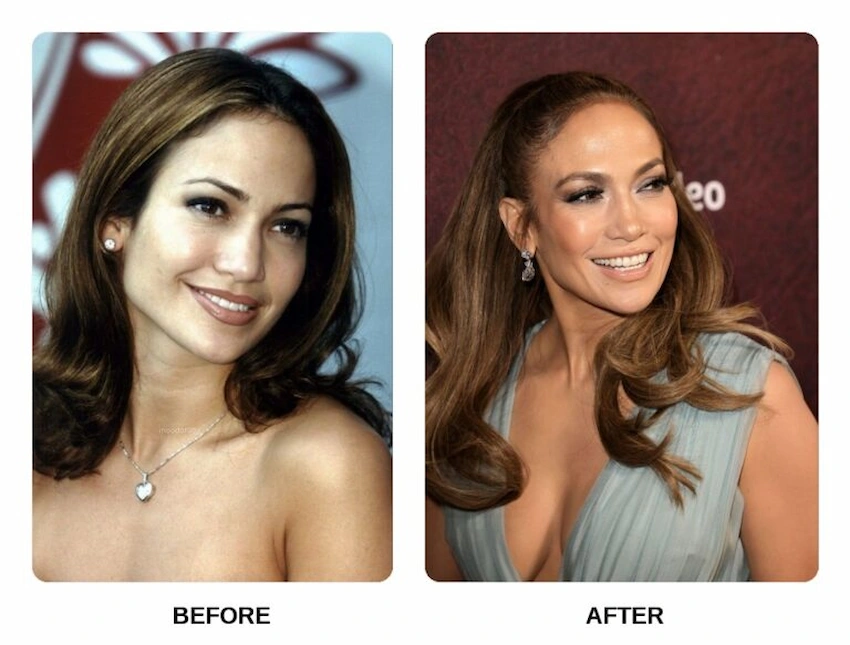 jennifer lopez teeth before after