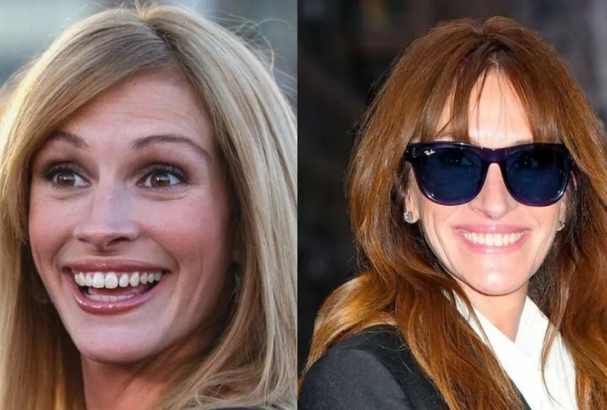 julia roberts teeth before after