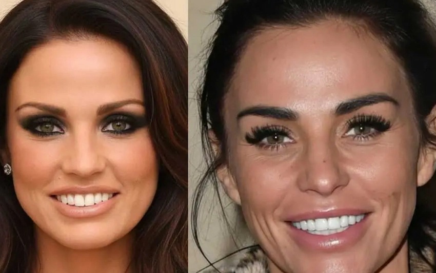 katie price teeth before after