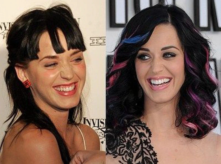 katy perry teeth before after