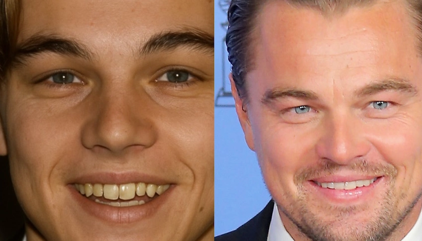 leonardo dicaprio teeth before after