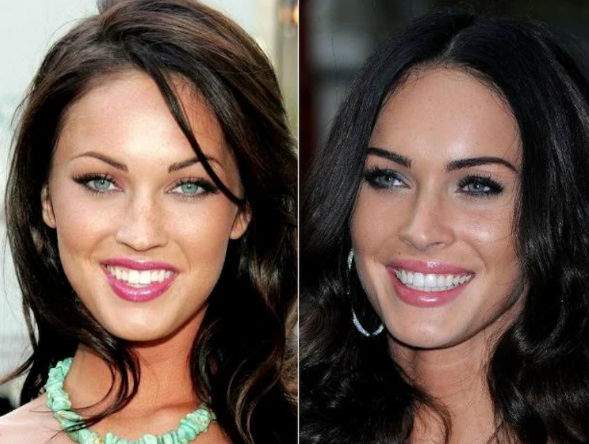 megan fox teeth before after