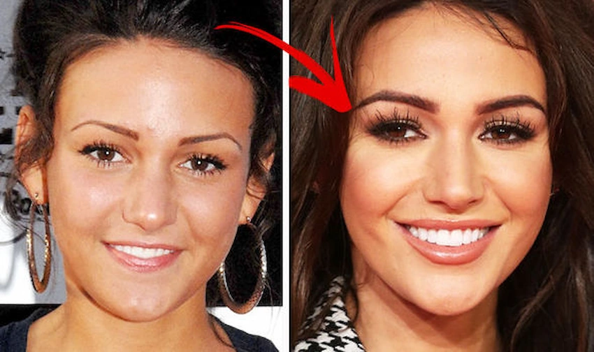 michelle keegan teeth before after