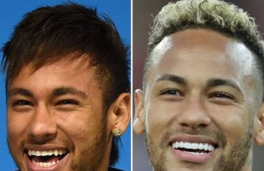 neymar jr teeth before after