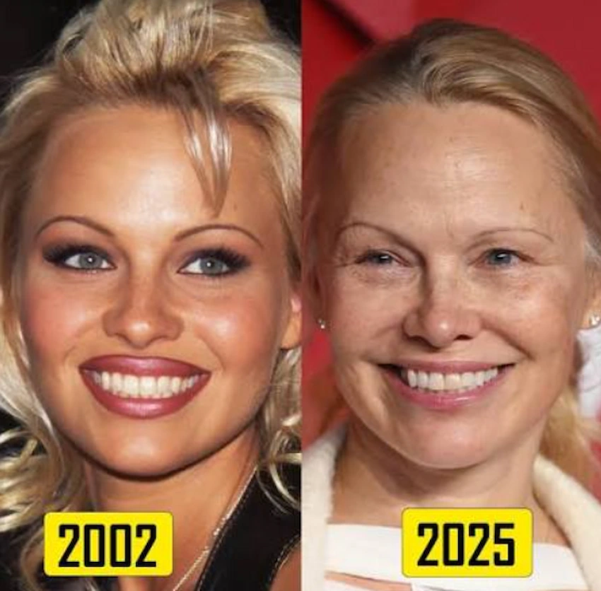 pamela anderson teeth before after