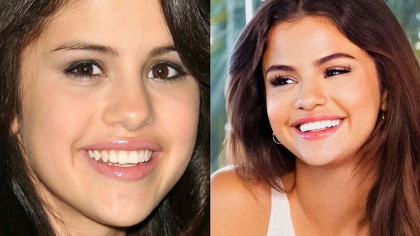 selena gomez teeth before after
