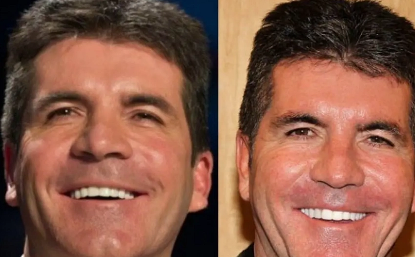 simon cowell teeth before after