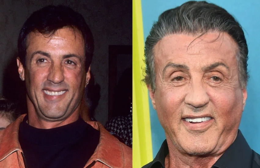 sylvester stallone teeth before after