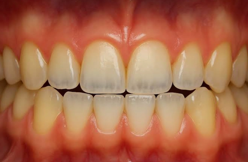 translucent front teeth enamel wear translucent front teeth enamel wear