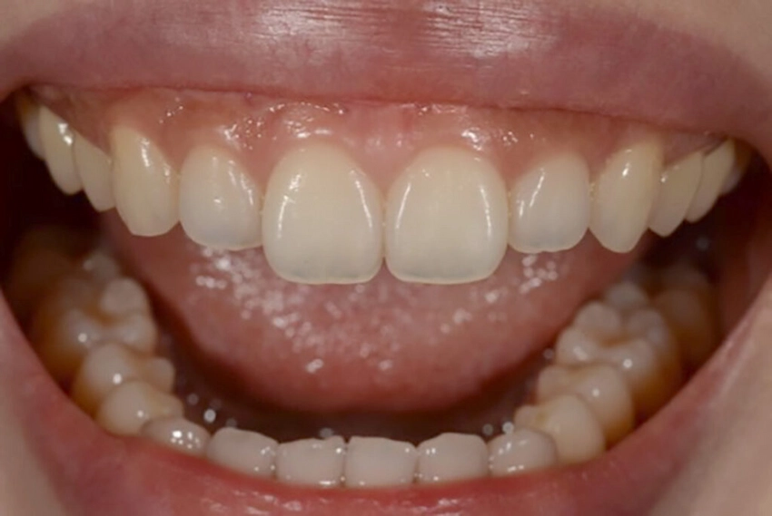 translucent teeth before treatment translucent teeth before treatment