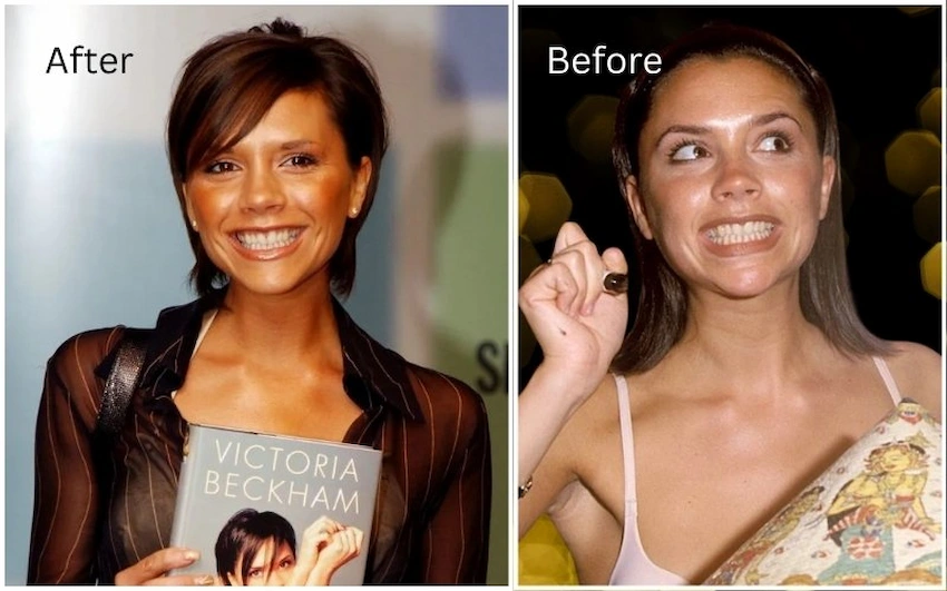 victoria beckham teeth before after victoria beckham teeth before after