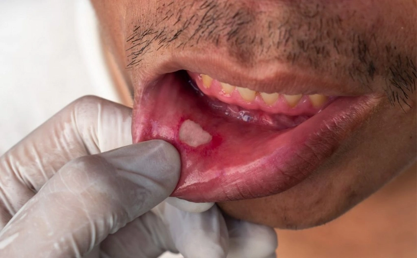 what is an aphthous ulcer