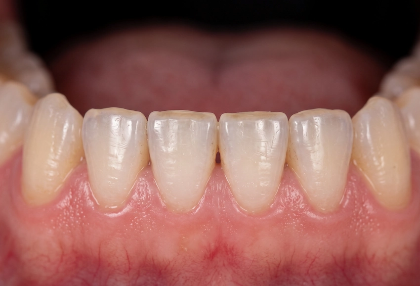worn teeth from night grinding worn teeth from night grinding