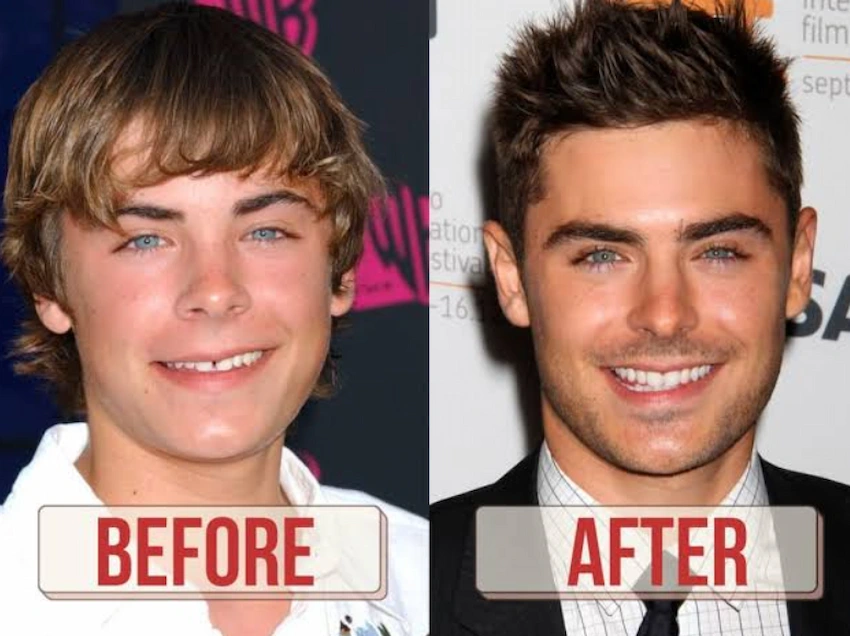 zac efron teeth before after