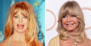 goldie hawn teeth before after