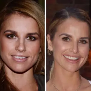 vogue williams teeth before after