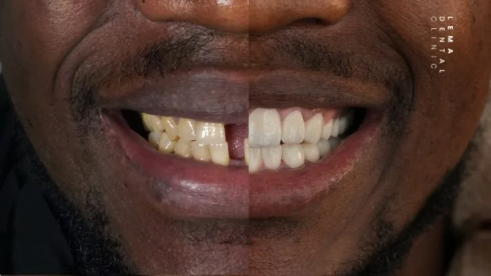 Hollywood Smile in Turkey cost