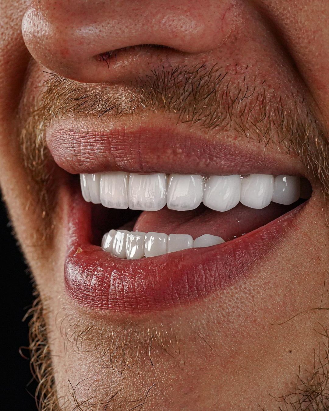 All on 4 implante dental