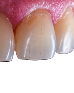Tartarul subgingival