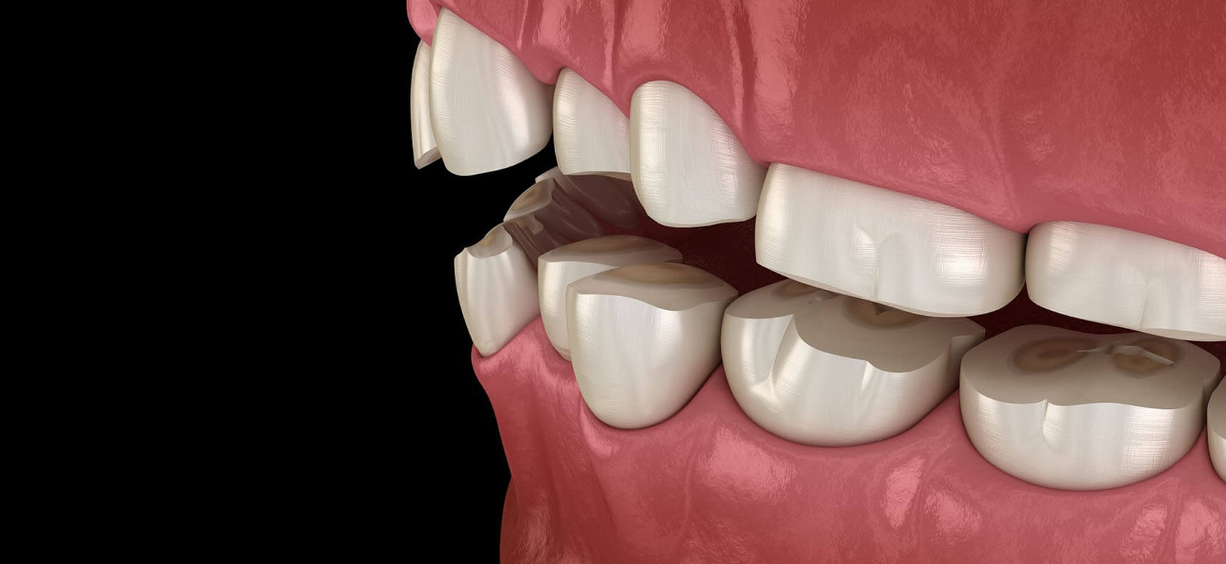 Understanding Bruxism: Causes And Treatments