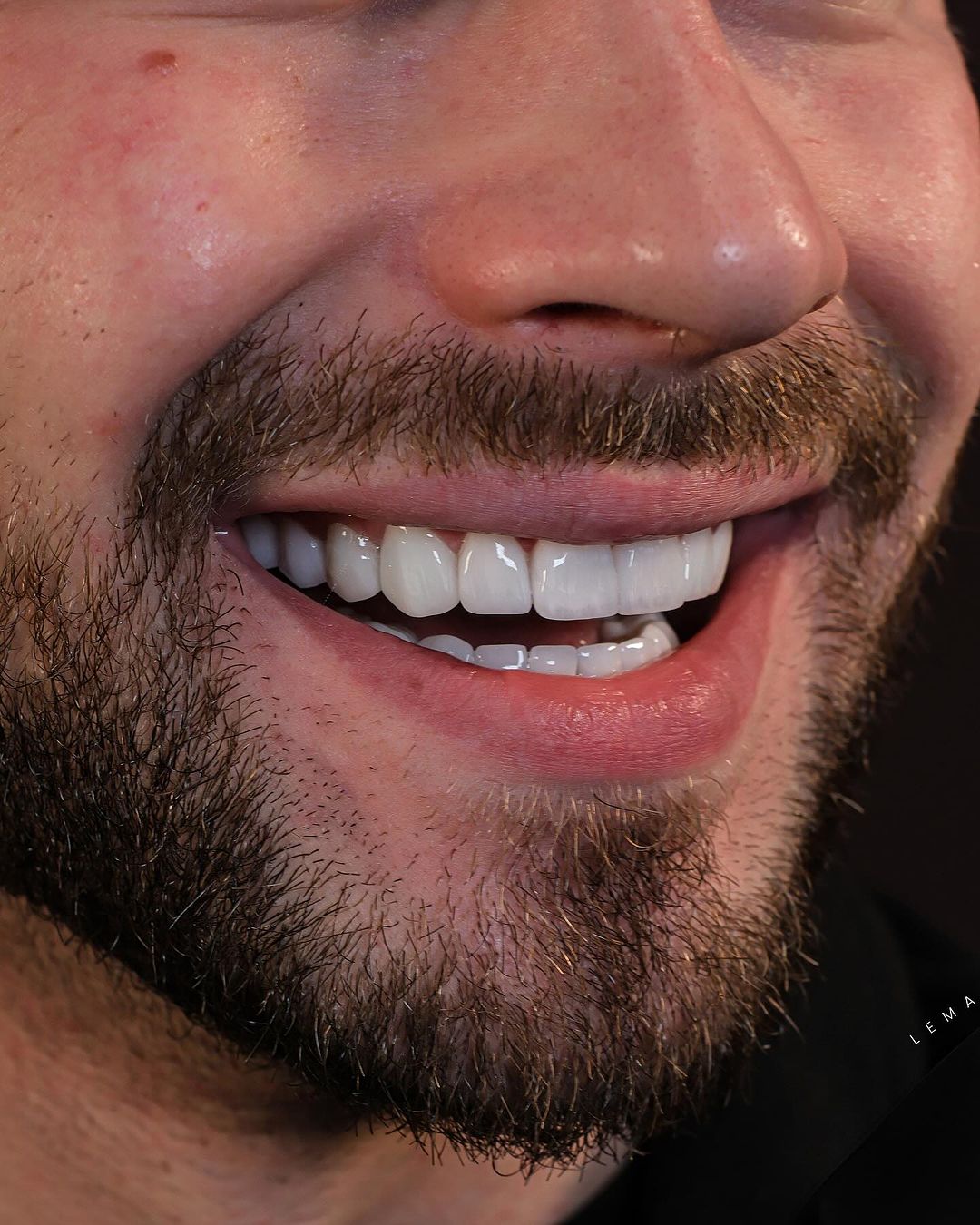 Emax Dentar Fațetele Furnier