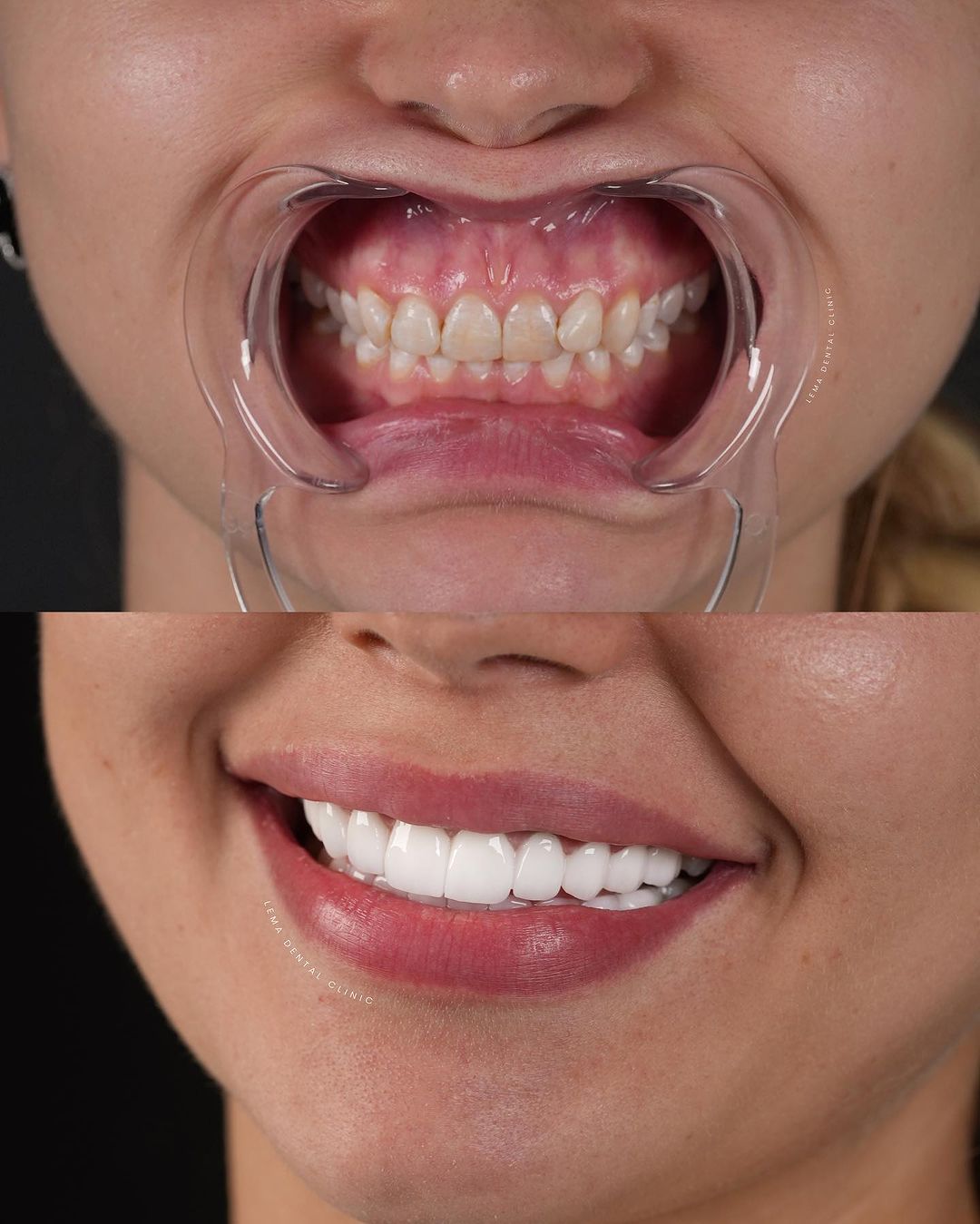 Emax dentar Fațetele