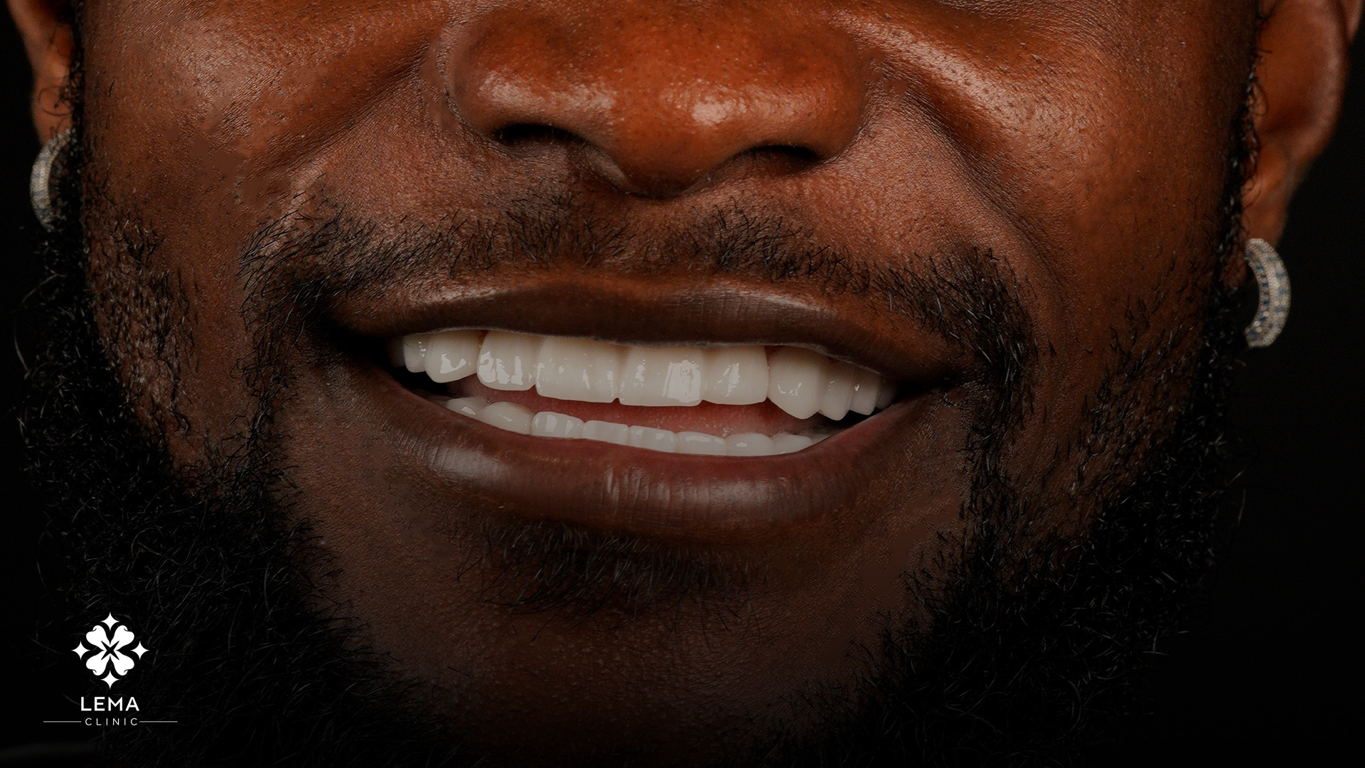 Hollywood Smile Sonrası Bakım İpuçları