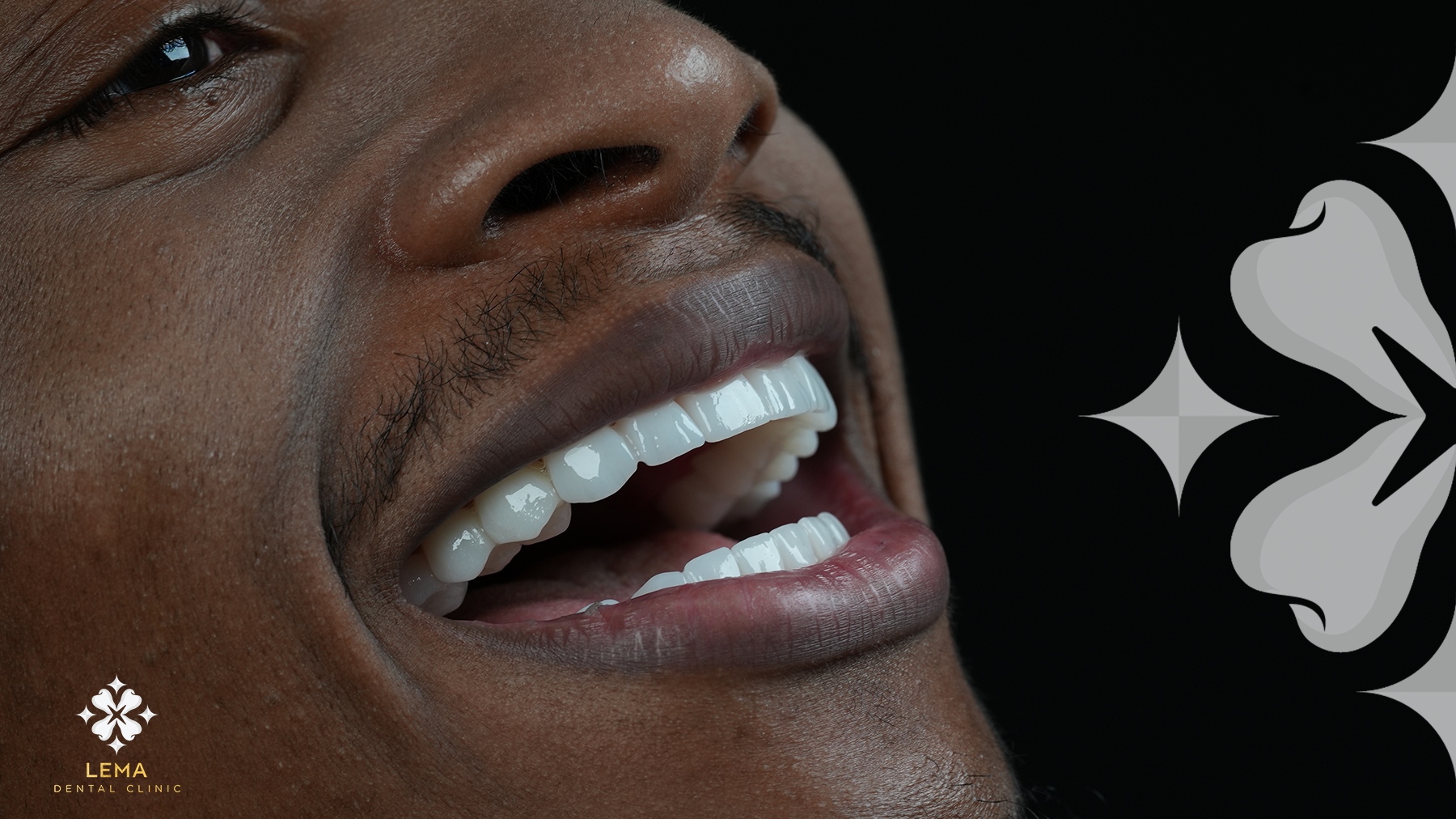 Implantation vs. Facettes Pour Un Relooking Du Sourire