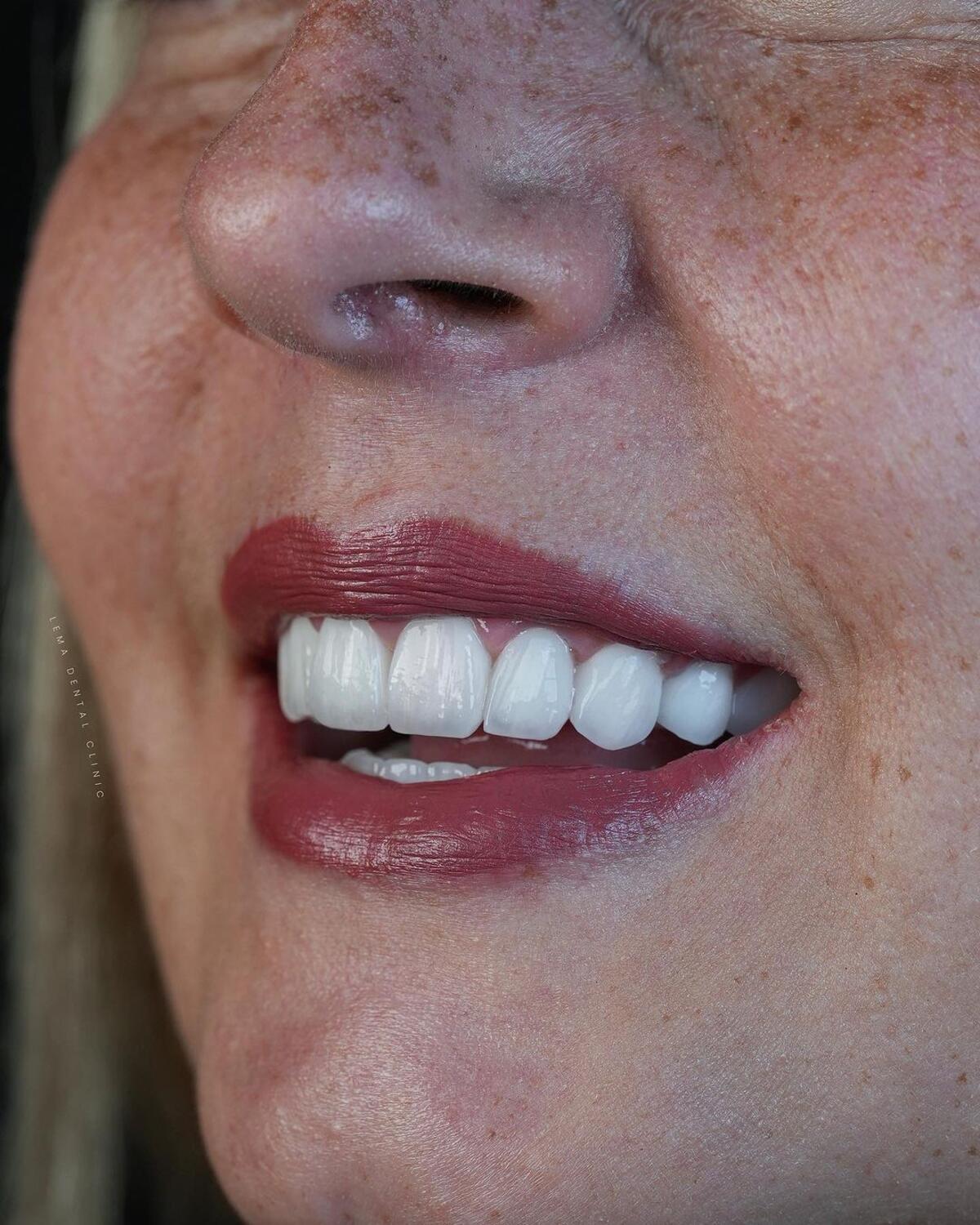 Implant vs. Veneers Smile Makeover