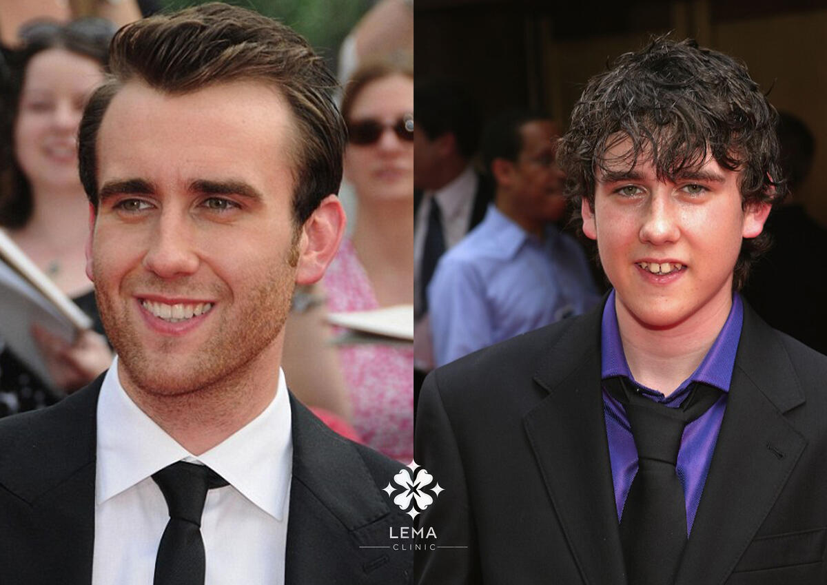 Matthew Lewis Dientes Perfectos 2024 - Clinica Lema