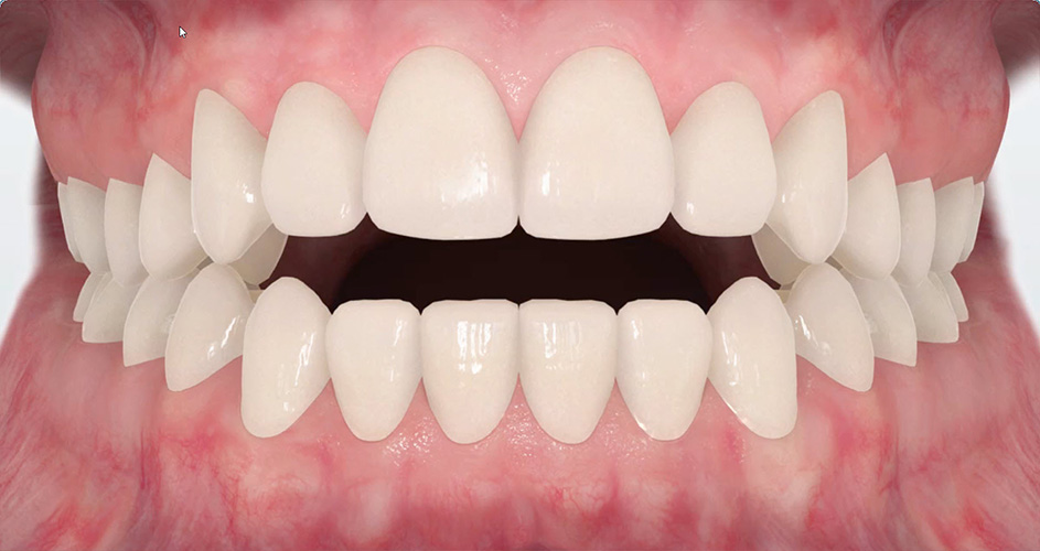 Understanding And Treating Open Bite
