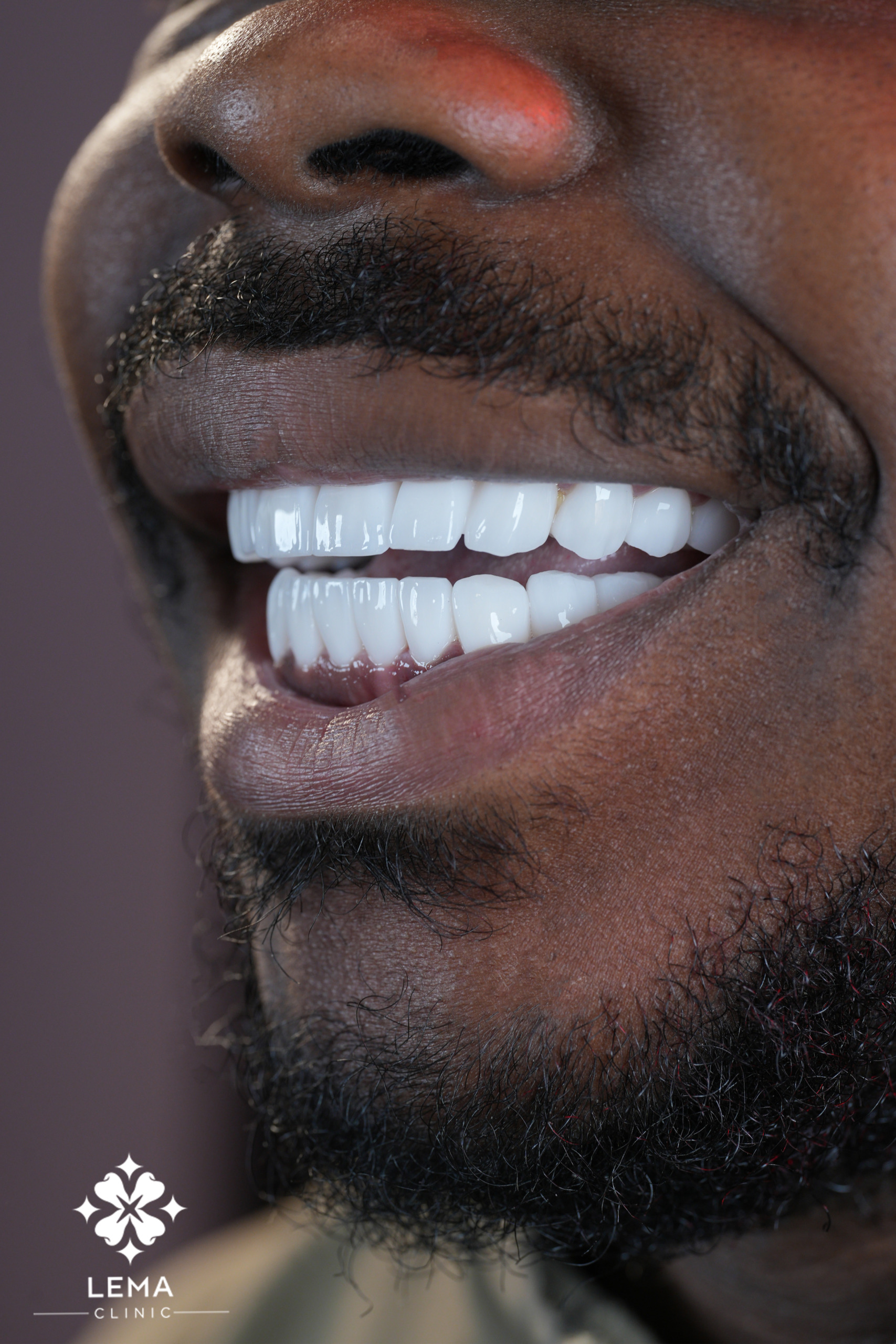 Pilier Implants Dentaires