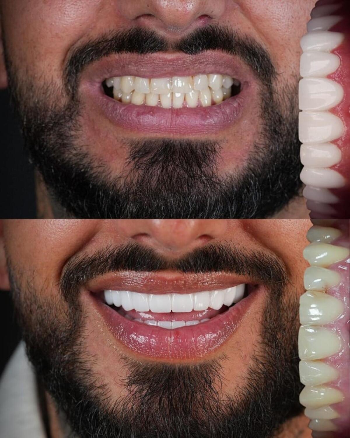 kim-kardashian-teeth Porcelain dental veneers