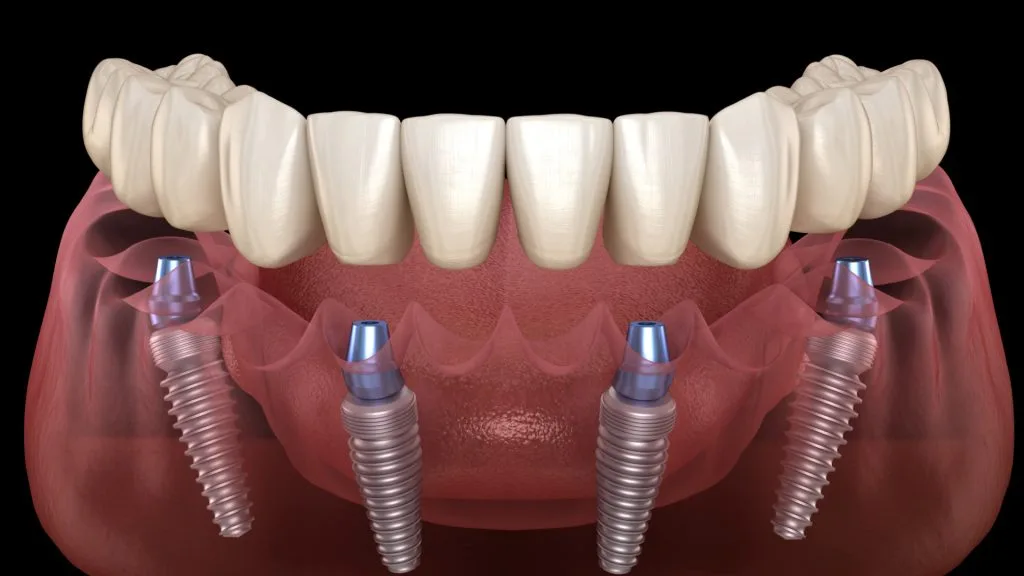 Implants dentaires All on 4