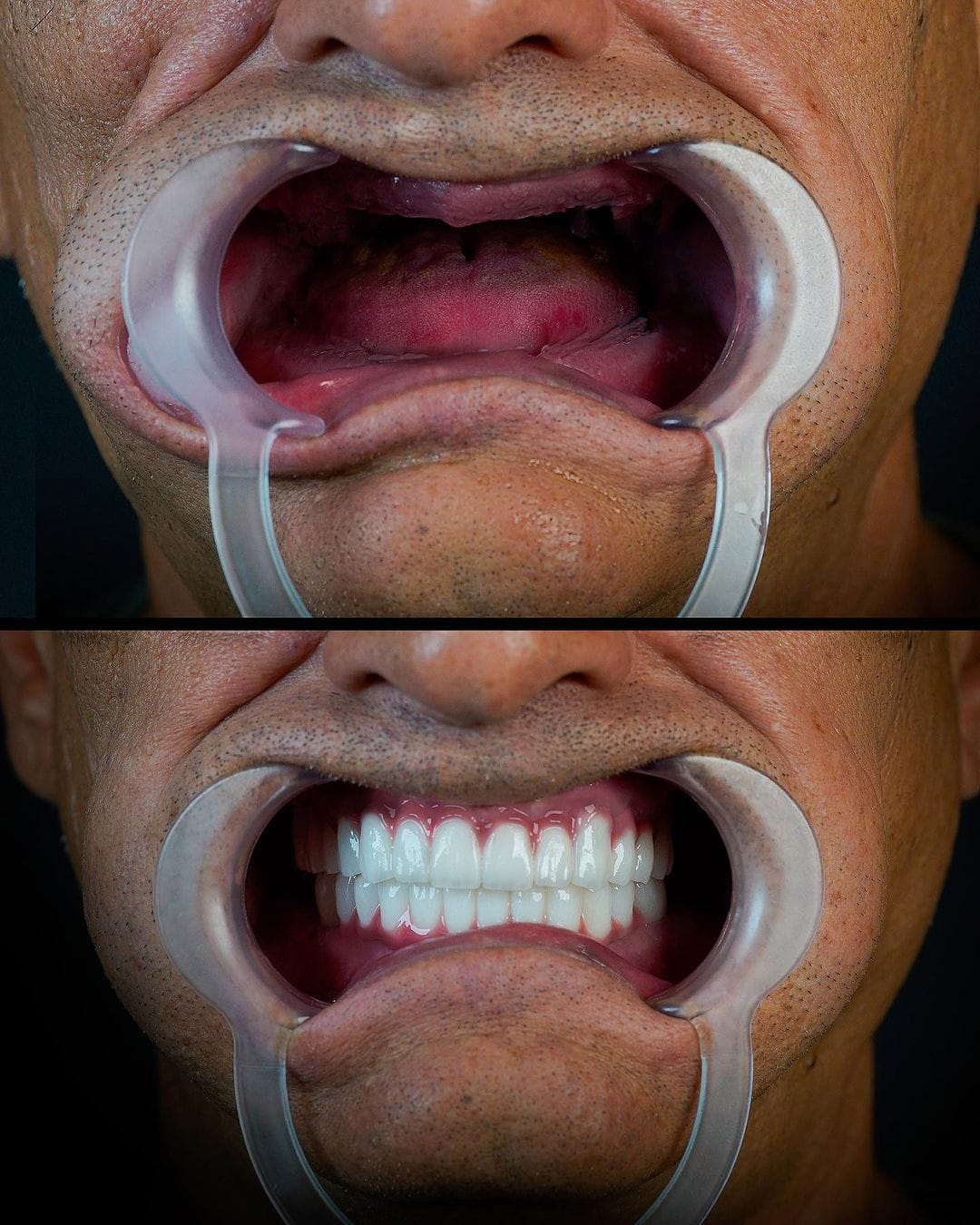 All on 4 implant dentar