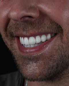 best teeth whitening