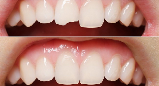 Diy Solutions For Hiding A Broken Tooth