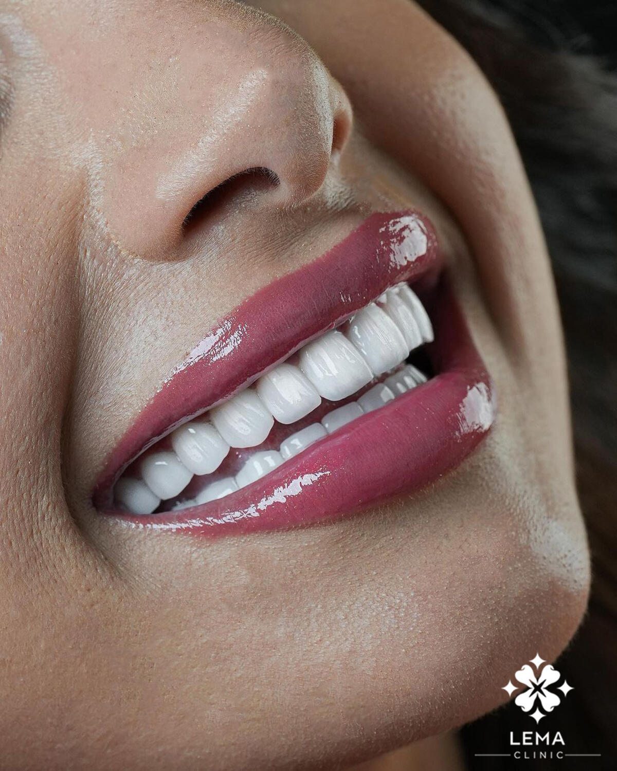 Top 10 Symptom Of Bruxism 2025 - Lema Dental Clinic