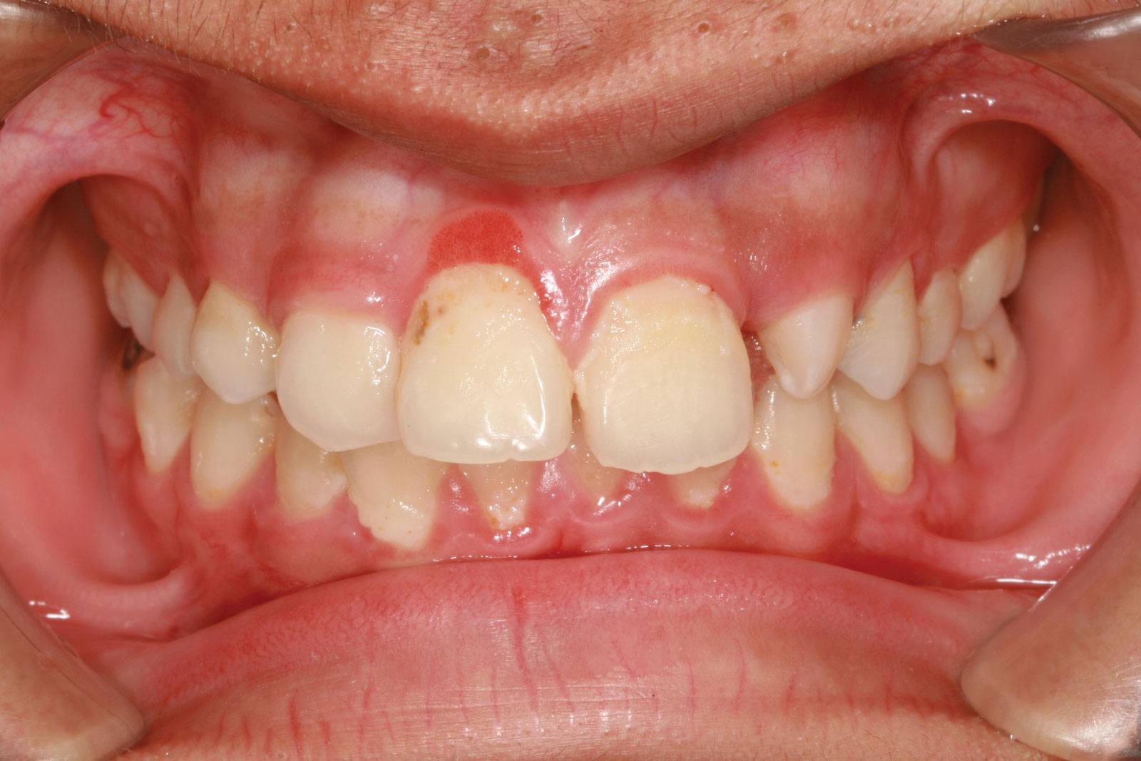 How To Treat Inflamed Gums Effectively