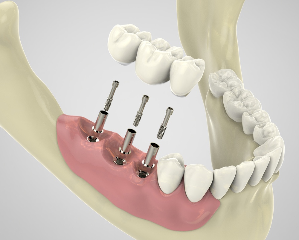 Tooth Crown Surgery: What To Expect