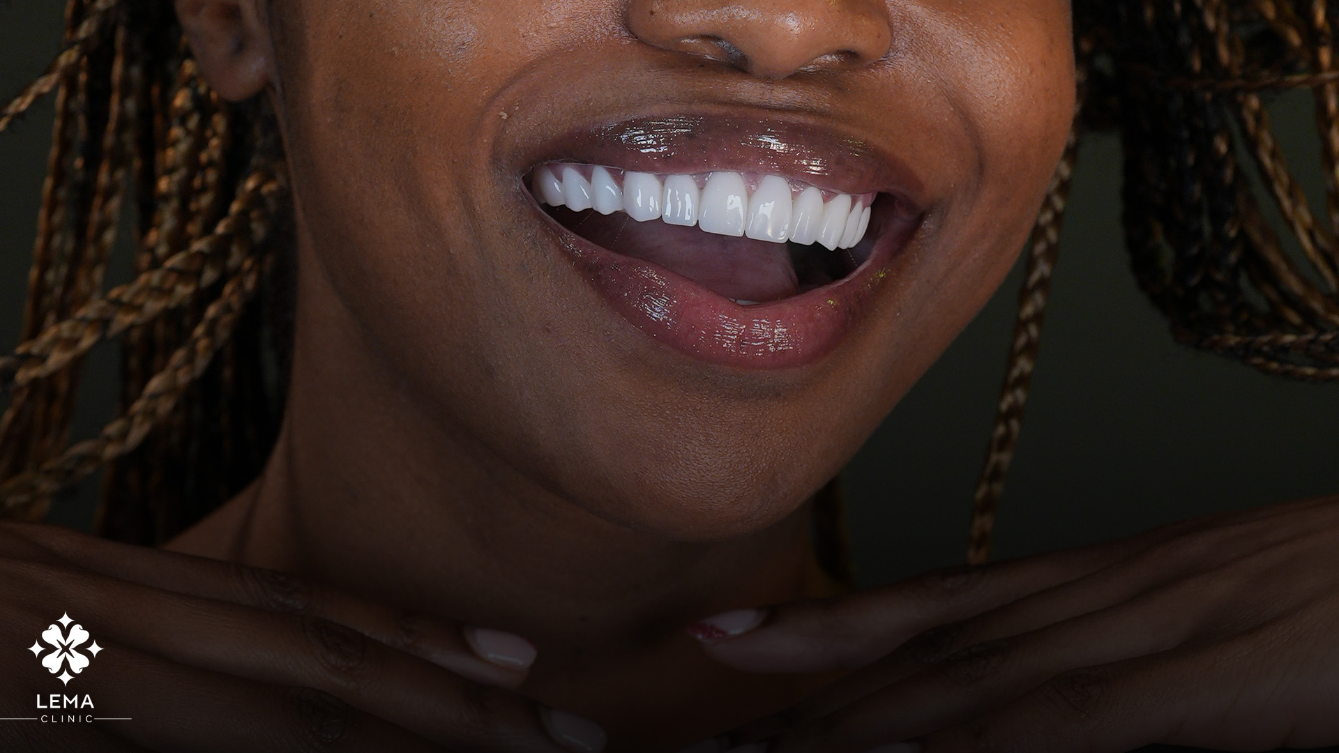 coronas dentales para realzar sonrisas