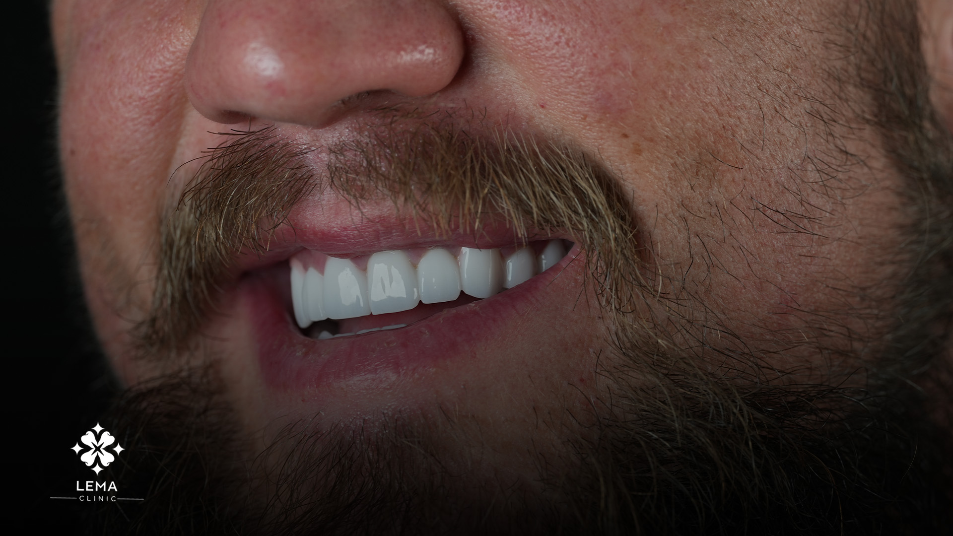 corone dentali per esaltare i sorrisi