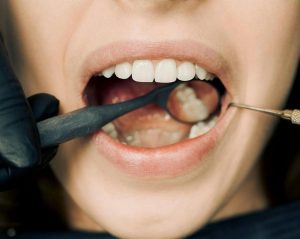 dental implants