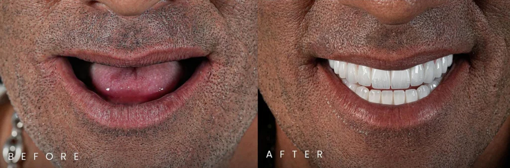 Dental Implant