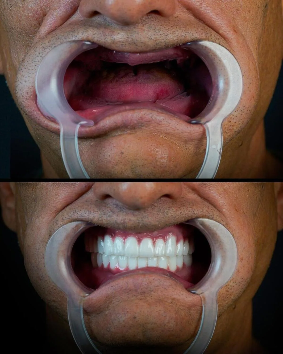 all-on-4-implant-procedure-step