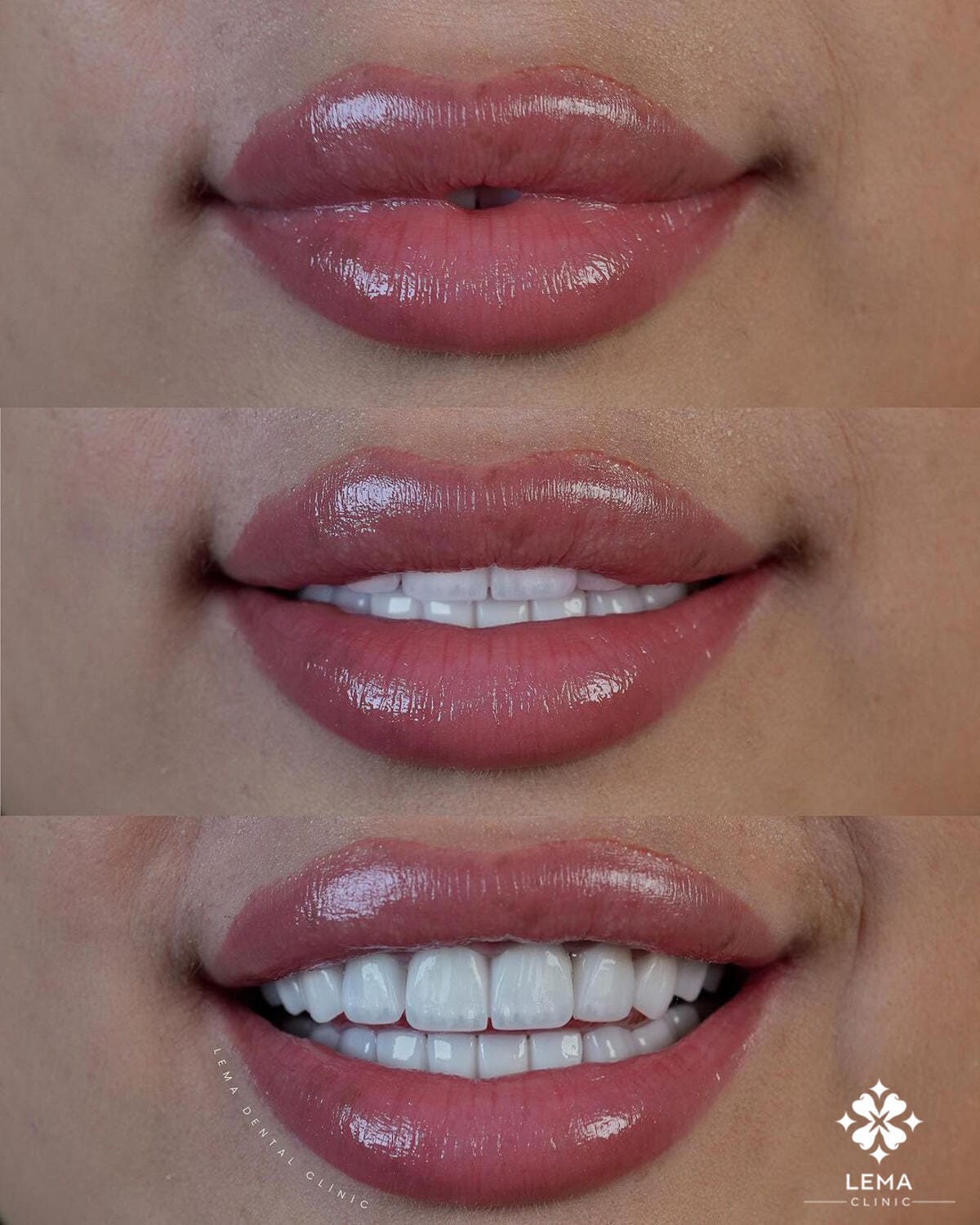 Understanding Dental Tartar and Its Effects 2024