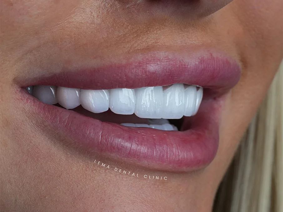 dental-veneers-istanbul