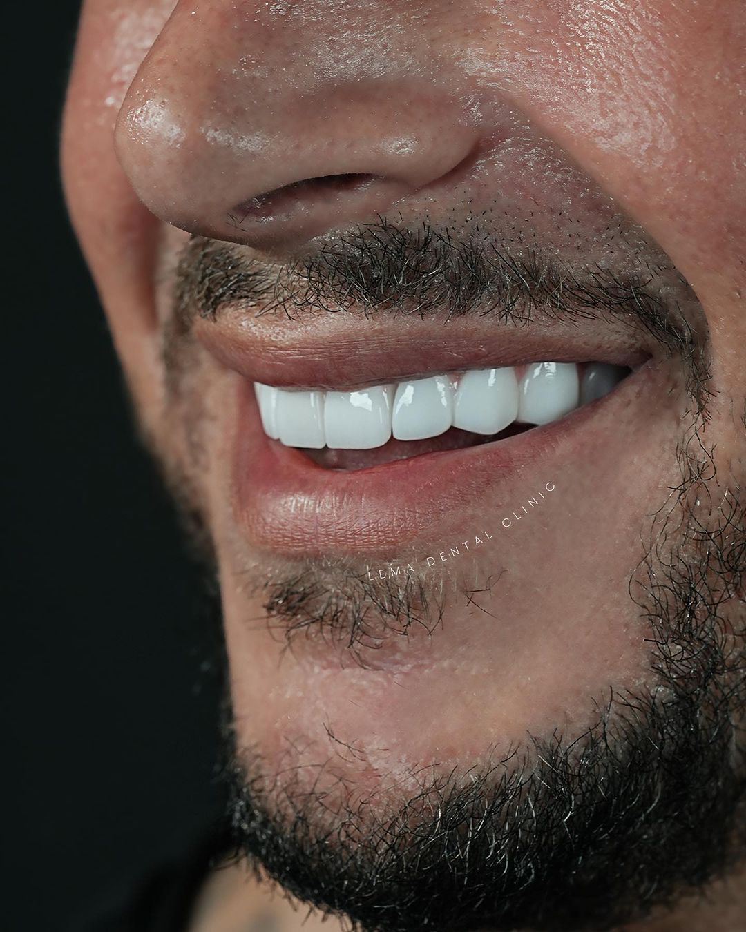 denti sensibili